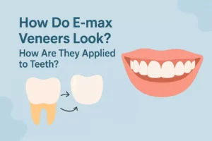 How Do E-max Veneers Look How Are They Applied to Teeth